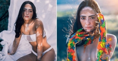 Após 12 anos escondendo vitiligo, modelo se torna exemplo de autoaceitação